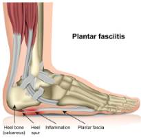 Plantar fasciitis